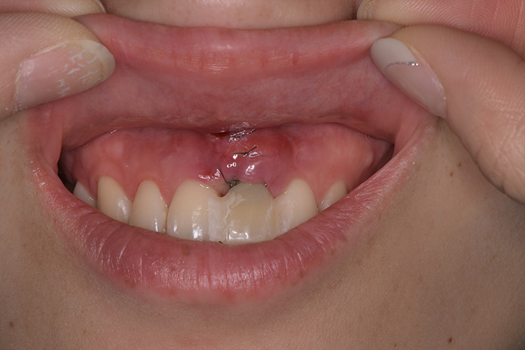 歯ぐき移植
