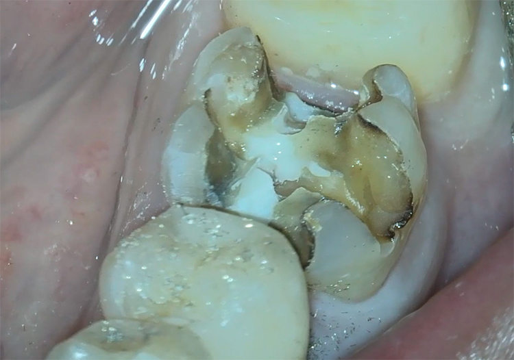 保険の銀歯(メタルインレー)の除去