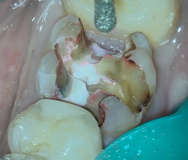 メタリックインレーの除去と虫歯治療
