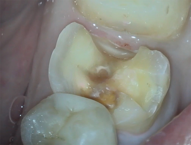 メタリックインレーの除去と虫歯治療