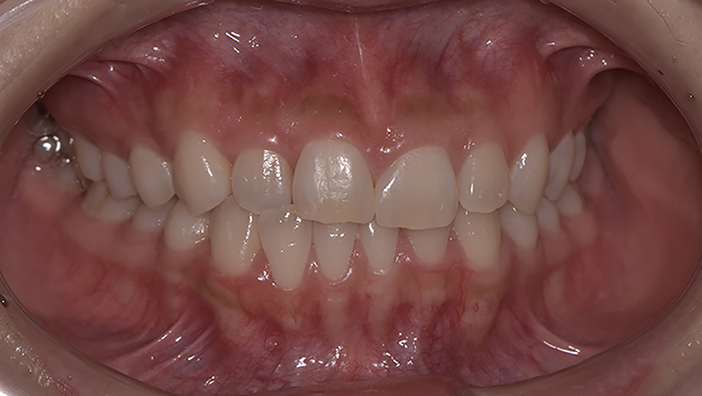 前歯のすき間(すきっ歯)をダイレクトボンディングで1日で修復 | 名取